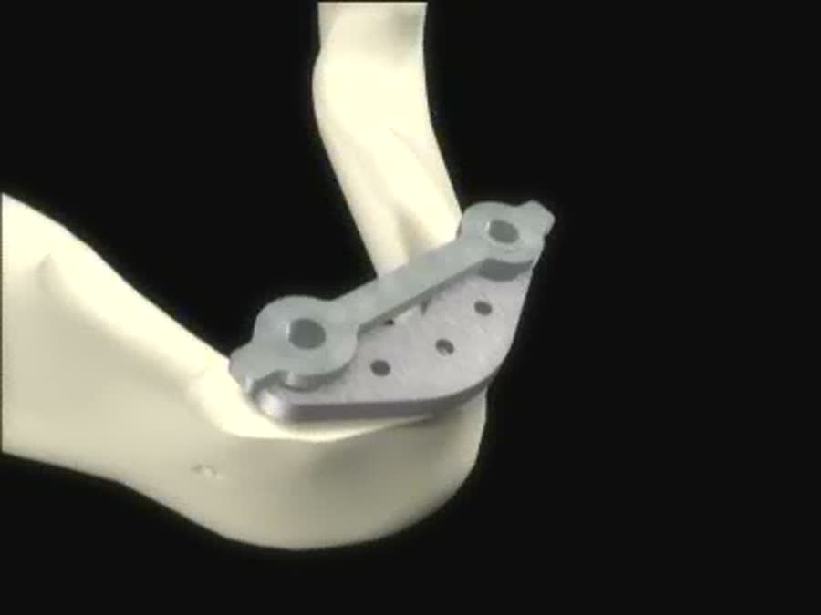 Rendered jaw with titanium reconstruction plate